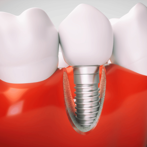 Implantes-dentários-Lube-Odontologia